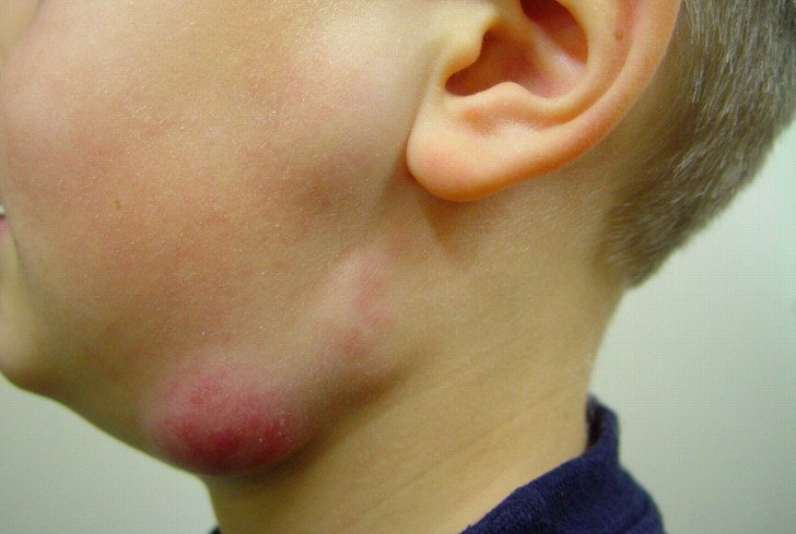 Що робити, якщо у дитини на шиї збільшені лімфовузли: причини запалення і лікування в домашніх умовах