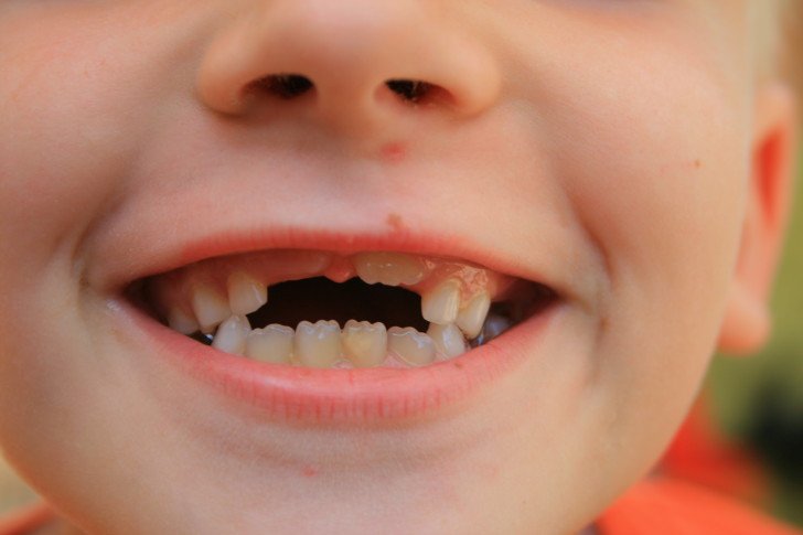 Терміни та схема заміни молочних зубів на постійні у дітей: які випадають першими, скільки триває прорізування?