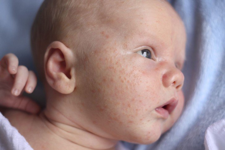Види шкірних висипань у дітей: фото висипки на грудях, спині і по всьому тілу з поясненнями