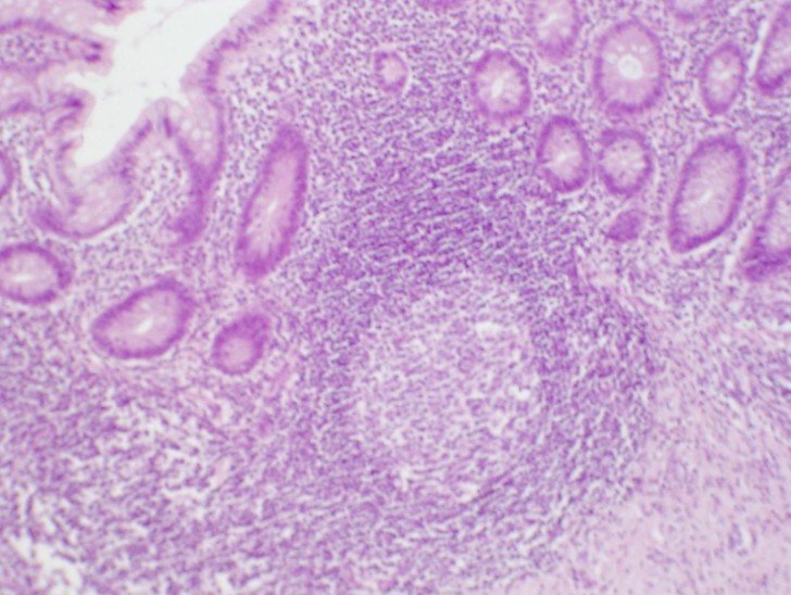 Риноцитограмма у дітей: норма і розшифровка мазка з носа на нейтрофіли, еозинофіли і інші види лейкоцитів