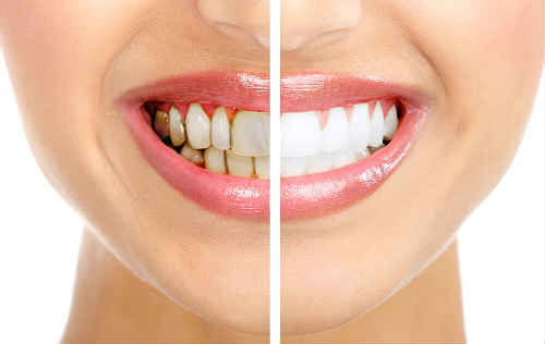 Зубний камінь — швидке видалення в домашніх умовах без шкоди