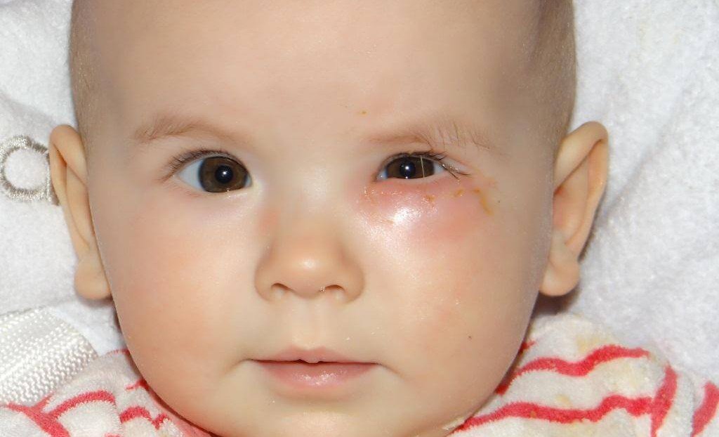 Що робити, якщо у новонародженого гноїться око: чим обробляти, щоб позбутися від гною?