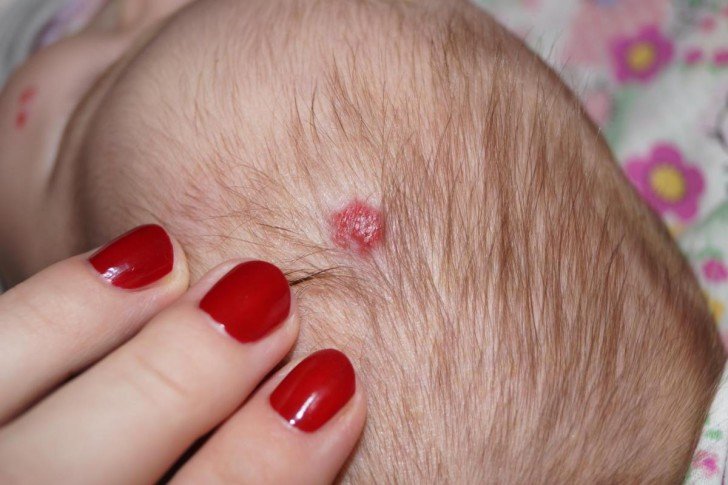 У дитини на голові утворилася шишка під шкірою — що це може бути?