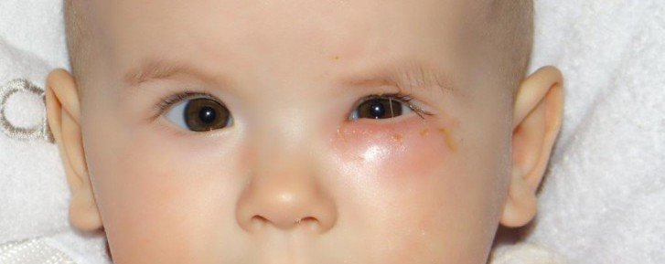 Зондування слізного каналу очей у дітей до року: як проходить операція у новонароджених, які є наслідки?