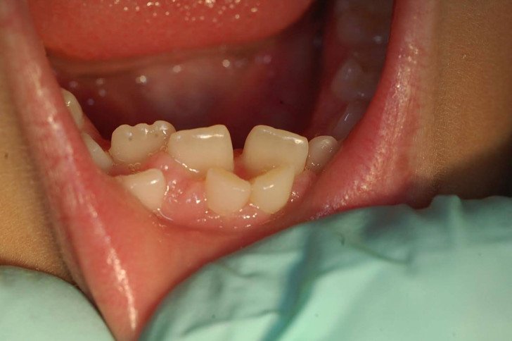 Коли прорізуються і випадають молочні зуби: схема і строки зміни прикусу у дітей за віком
