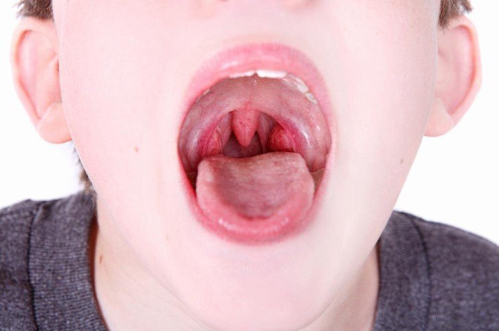 Як виглядає здорове і хворе червоне горло у дитини, якими в нормі повинні бути мигдалики?