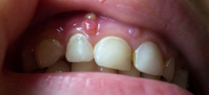 Що робити, якщо у дитини утворився свищ на десні молочного зуба: способи лікування в домашніх умовах