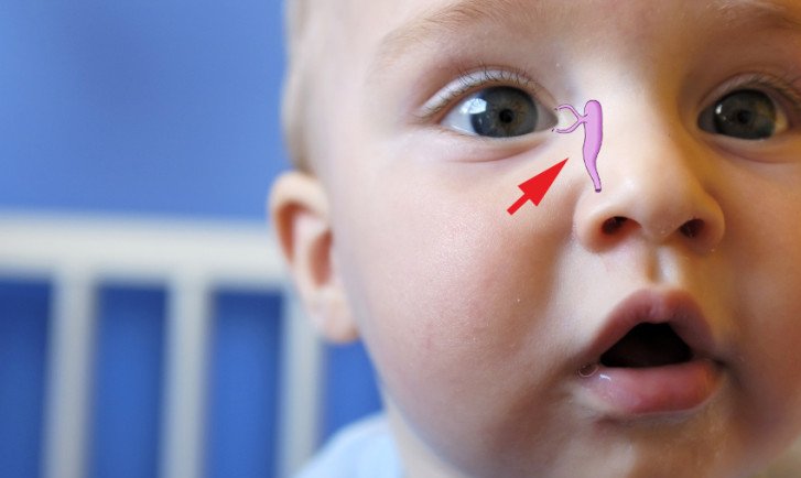 Зондування слізного каналу очей у дітей до року: як проходить операція у новонароджених, які є наслідки?
