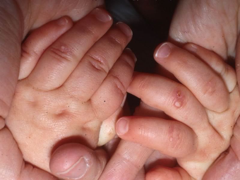 Водянисті пухирці і прищики на тілі дитини: фото з поясненнями висипи у вигляді пухирців на руках, ногах і обличчі