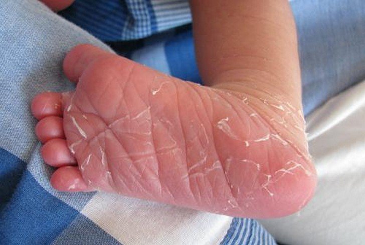 Чому у дитини на пальцях рук і ніг облазить і лущиться шкіра: причини і методи лікування
