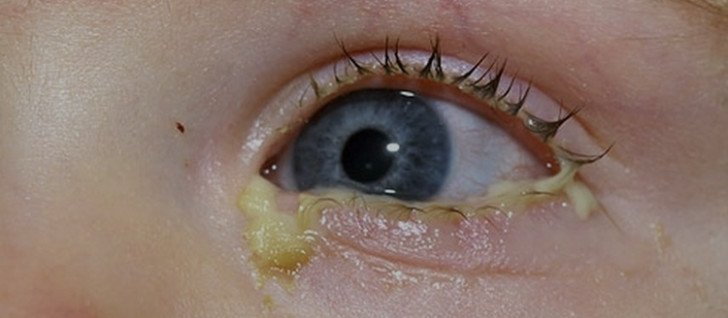 Що робити, якщо у дитини гнояться очі: чому це відбувається і як лікувати виділення?