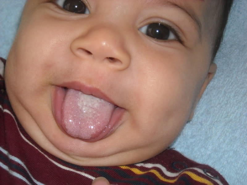 Червоні плями на слизовій рота, неба і горла у дитини: види висипу з фото і поясненнями