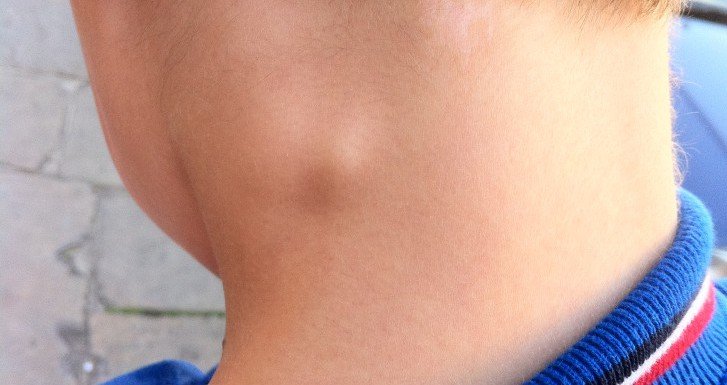 Що робити, якщо у дитини на шиї збільшені лімфовузли: причини запалення і лікування в домашніх умовах