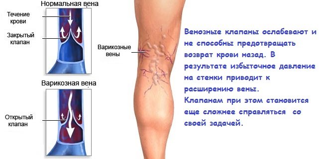 Варикозне розширення вен на ногах лікування в домашніх умовах