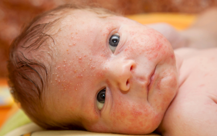 Вугрі та прищі у дитини на попі: причини алергії і сухості шкіри, способи лікування