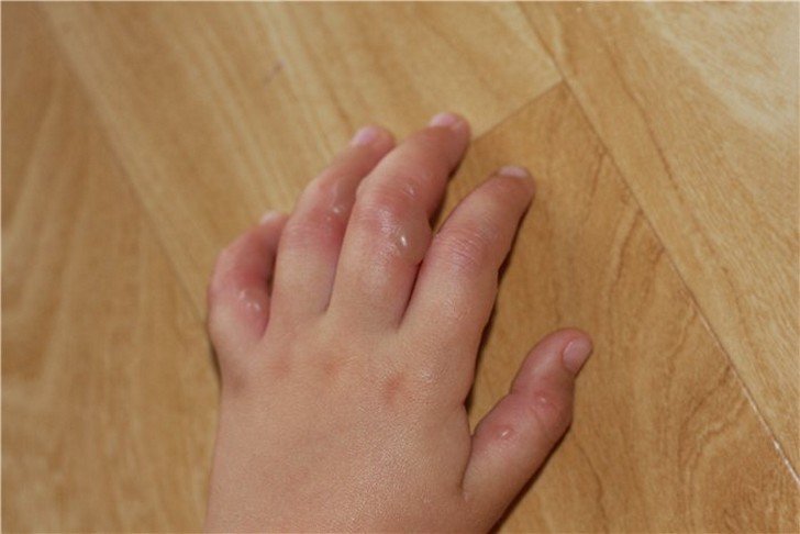 Водянисті пухирці і прищики на тілі дитини: фото з поясненнями висипи у вигляді пухирців на руках, ногах і обличчі