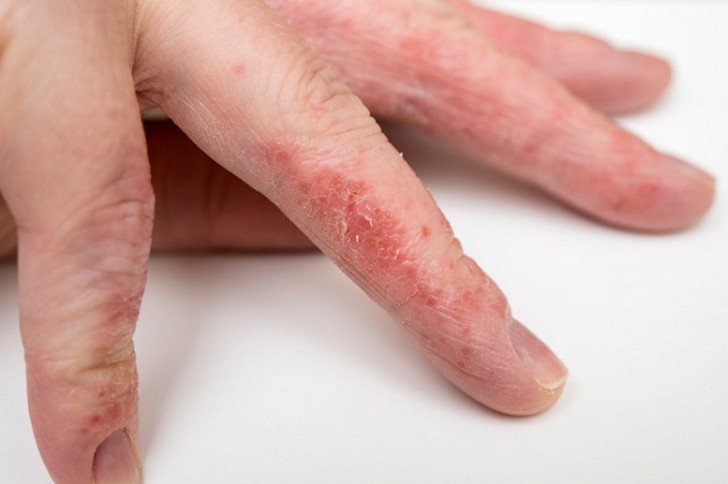Чому у дитини на пальцях рук і ніг облазить і лущиться шкіра: причини і методи лікування