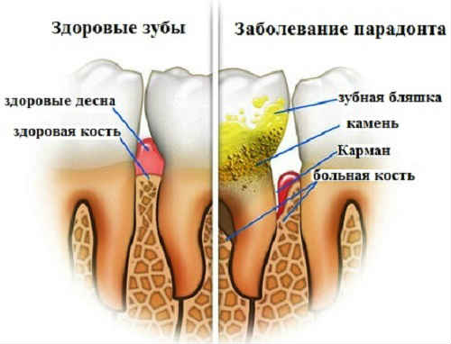 Зубний камінь — швидке видалення в домашніх умовах без шкоди