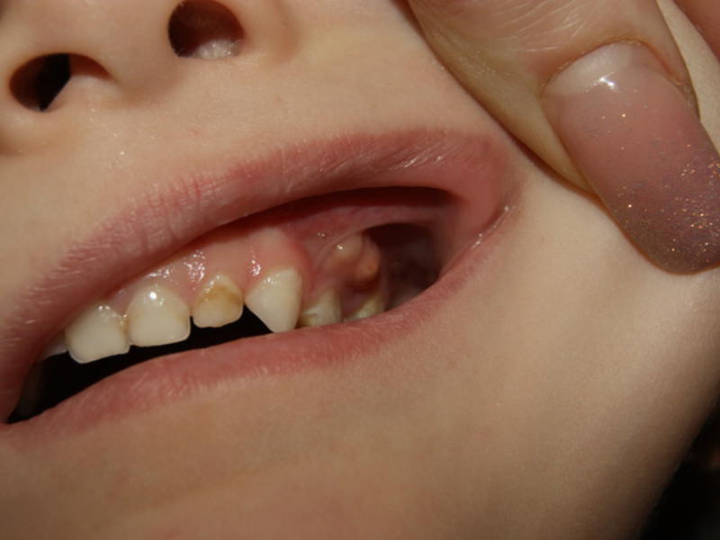 Що робити, якщо на десні у дитини зявилася шишка: як лікувати гнійник над молочним зубом?