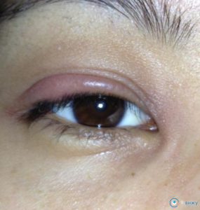Чому опухлі повіки очей: нижнє та верхнє всі відомі причини