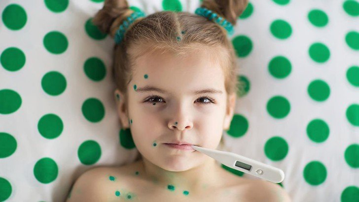 Щеплення для дітей від вітряної віспи: як називається вакцина проти вітрянки, скільки вона діє і коли її роблять?