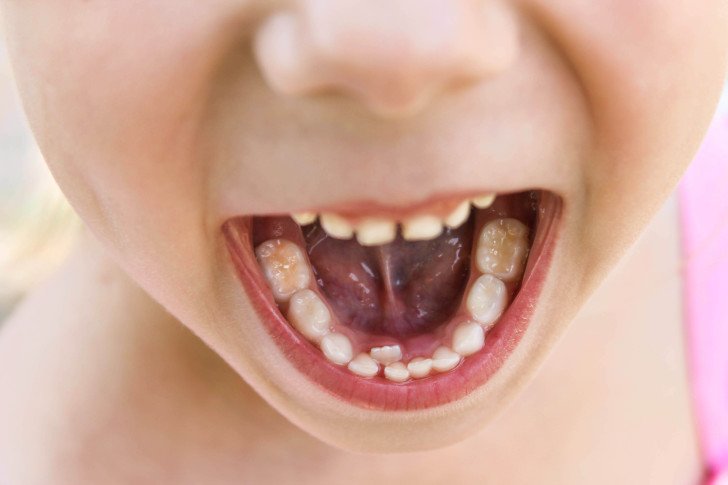 Показання до видалення молочного зуба дитині: чи боляче це і будуть наслідки?