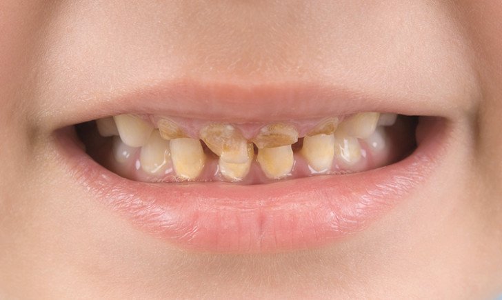 Процедура сріблення молочних зубів у дітей при карієсі: переваги методу і альтернативи