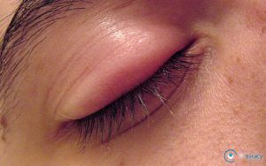 Чому опухлі повіки очей: нижнє та верхнє всі відомі причини