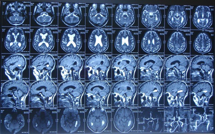 Що показує МРТ та КТ головного мозку у новонароджених та дітей старшого віку?