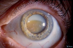 Ознаки катаракти очі: як розпізнати перші симптоми на ранньому етапі розвитку хвороби