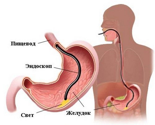Біопсія шлунка з допомогою ендоскопії: показання та протипоказання