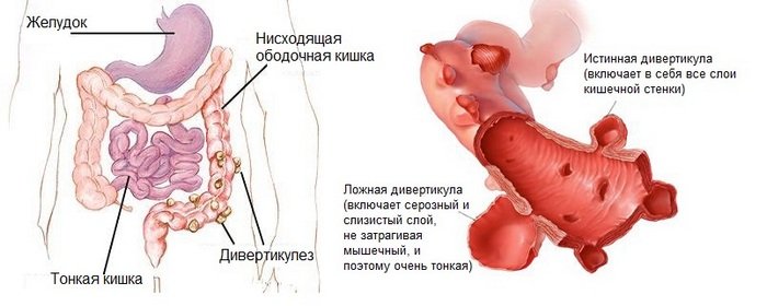Способи лікування дивертикулеза кишечника, його причини і симптоми