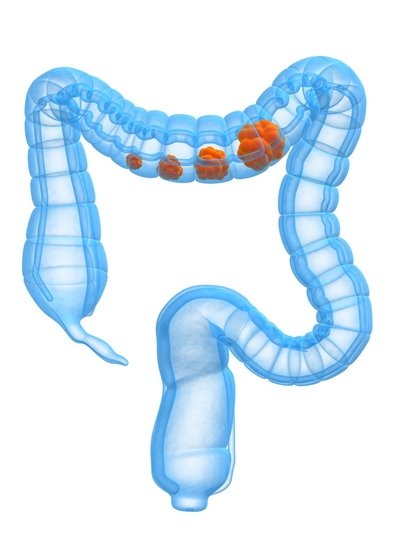 Причини зубчастої та тубулярної аденома товстої кишки, їх лікування
