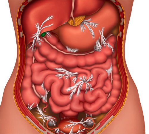 Причини появи спайок в кишечнику і способи їх лікування