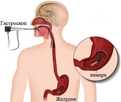 Як підготуватися до гастроскопії шлунка та що можна їсти