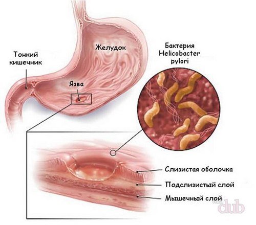 Симптоми захворювання шлунка, види хвороб та їх лікування
