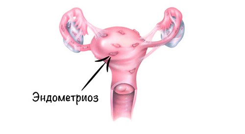 Симптоми і лікування ендометріозу кишечника