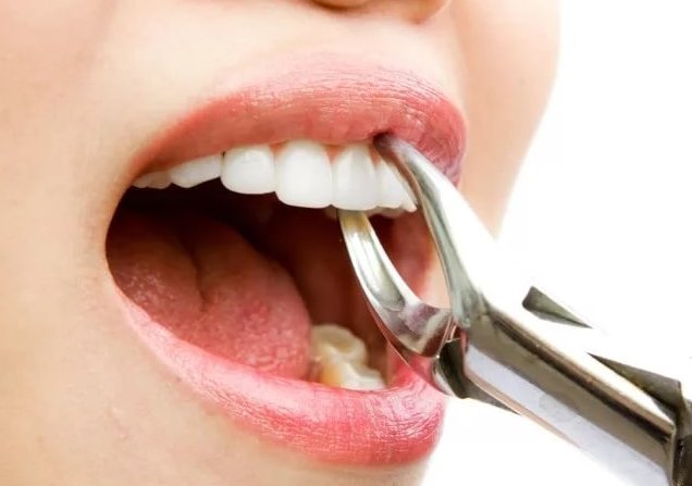 Неприємний запах з рота після видалення зуба: особливо мудрості