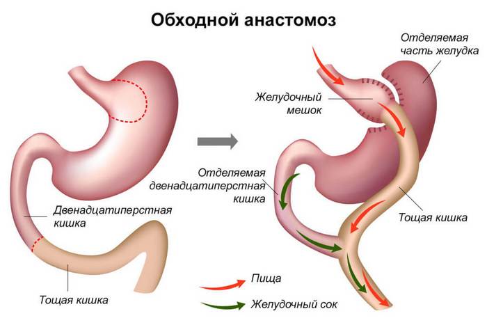 Що таке анастомоз кишечнику, його види, показання та проведення процедури
