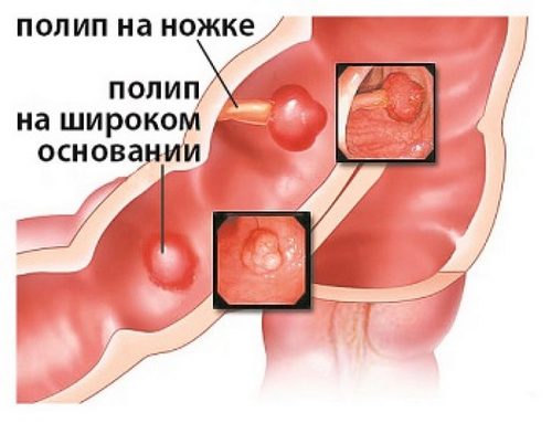 Ознаки і симптоми появи поліпів у кишечнику, їх видалення