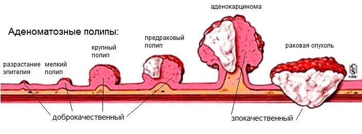 Симптоми пухлини в кишечнику, види і стадії їх розвитку