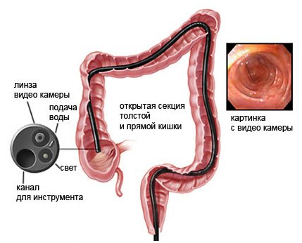 Як проводиться колоноскопія кишечника, її показання та протипоказання