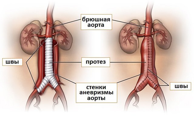 Атеросклероз черевного відділу аорти – симптоми і лікування