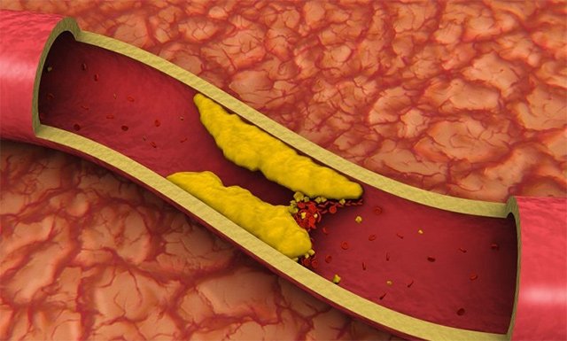 Холестеринові бляшки в судинах — симптоми і лікування