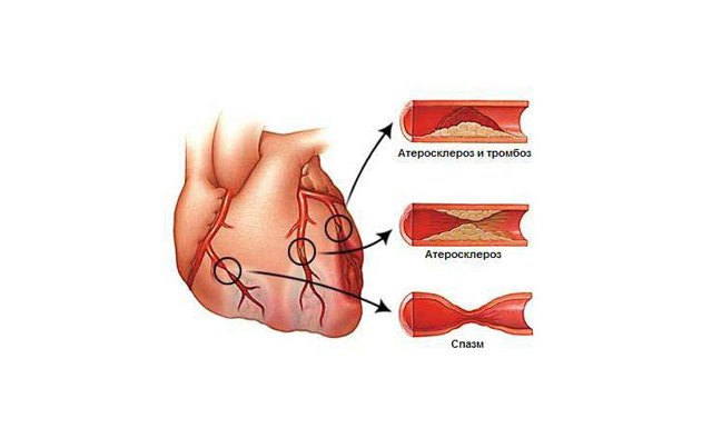 Атеросклероз аорти серця – симптоми і лікування