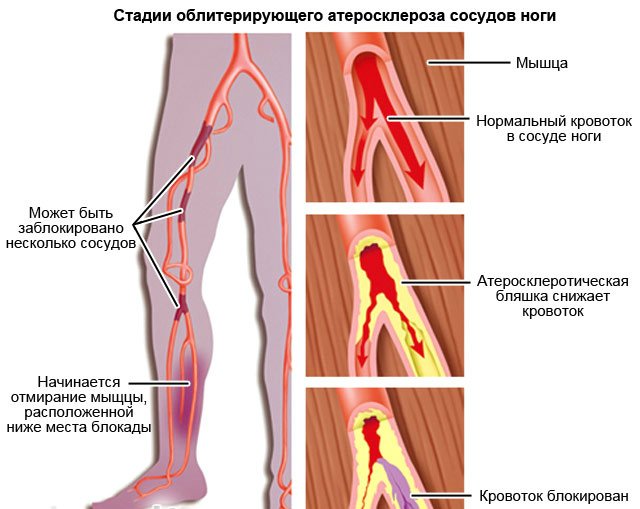 Особливості облітеруючого атеросклерозу судин ніг
