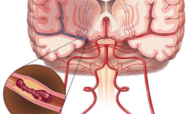 Що таке дифузний атеросклероз: особливості ураження судин головного мозку, серцевого мяза і нижніх кінцівок
