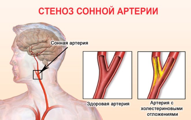 Сонна артерія: її характеристика та можливі захворювання