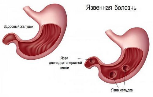 Кровоточива виразка шлунка і дванадцятипалої кишки