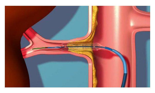Атеросклероз ниркових артерій – симптоми і лікування
